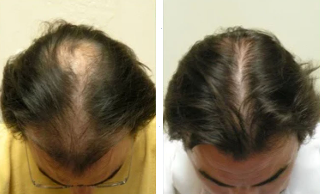 Before & After Laser Hair Treatment